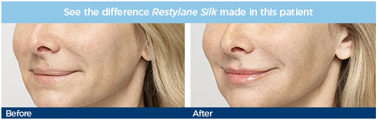 restylane_silk_patient